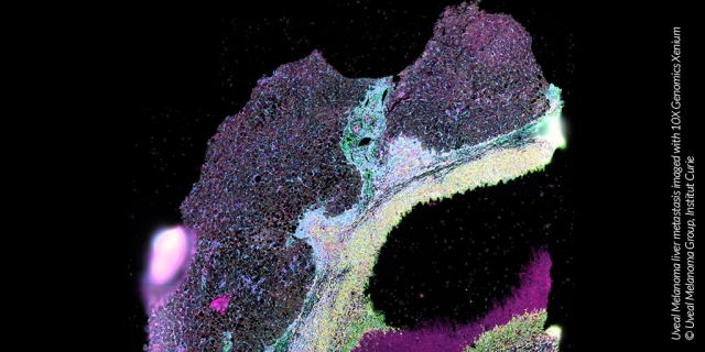 Generative artificial intelligence and network modelling for cancer diagnosis and treatment