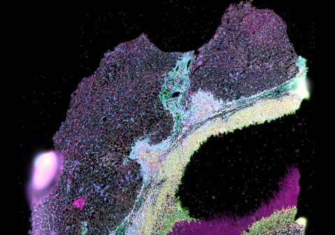 Generative artificial intelligence and network modelling for cancer diagnosis and treatment